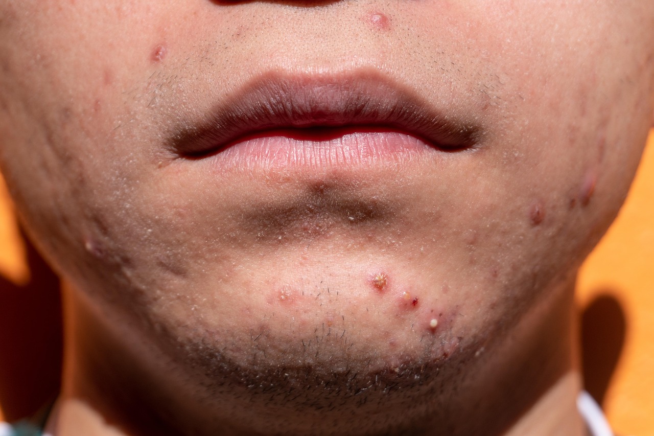 Ang Diet Mo, Susi sa Clear Skin? Bakit Kailangan Mong Tingnan ang Kinakain Mo!
